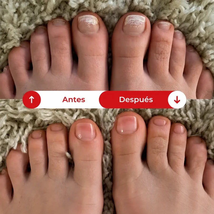 MicoDerm Parche Antifúngico para Hongos